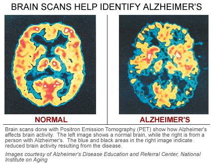 Assignment about alzheimer disease